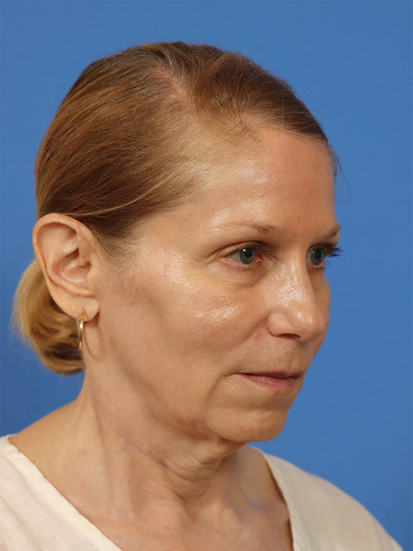 Neck Lift Before & After Image