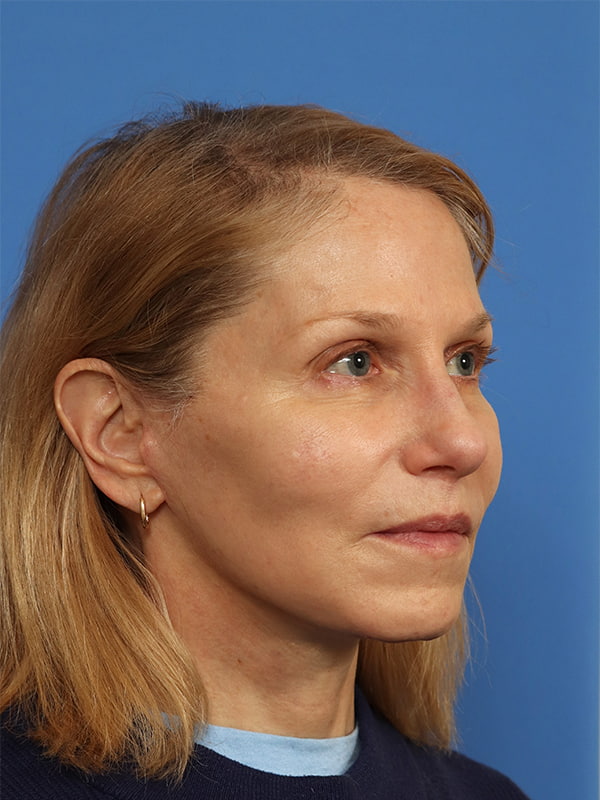 Neck Lift Before & After Image