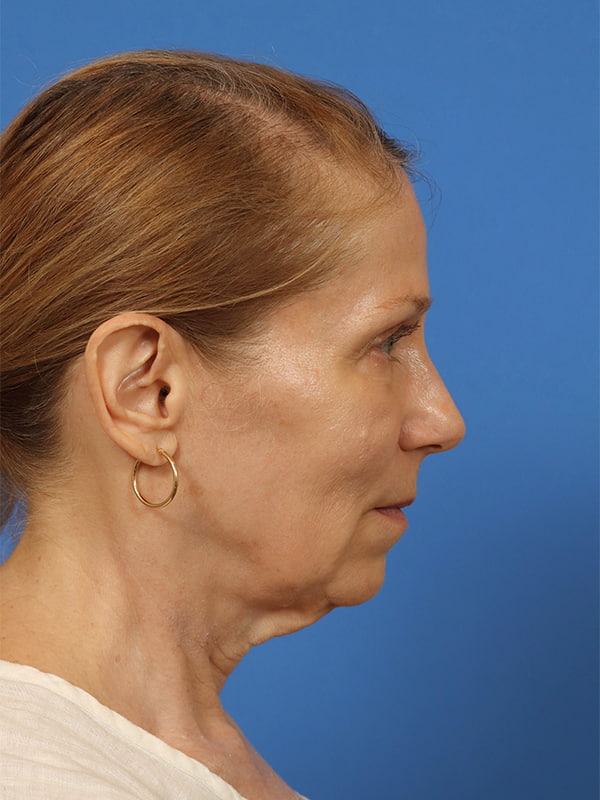 Neck Lift Before & After Image