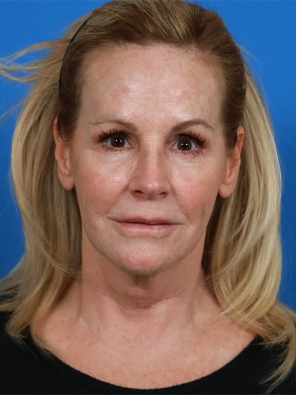 Neck Lift Before & After Image