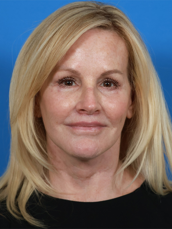 Neck Lift Before & After Image