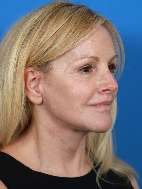 Neck Lift Before & After Image