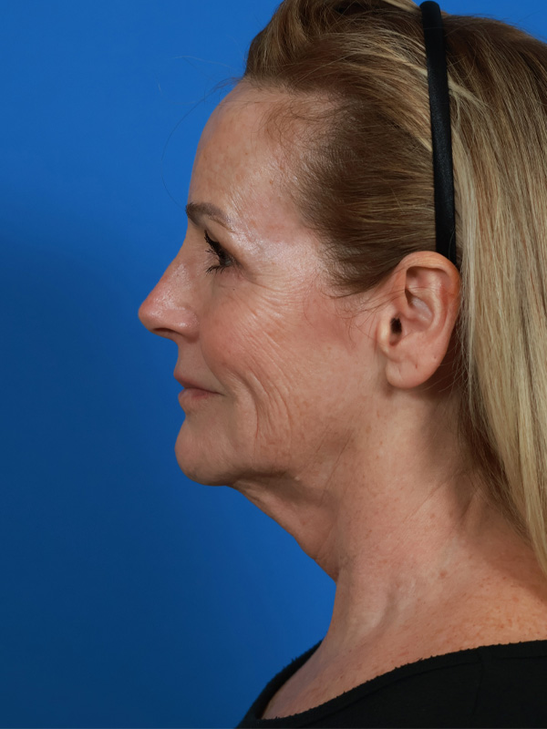 Neck Lift Before & After Image