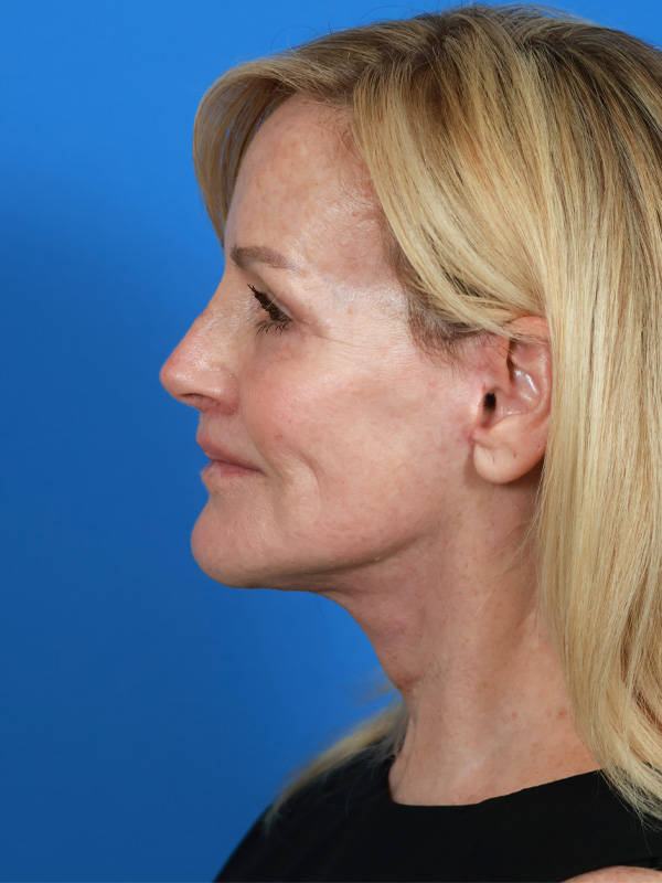 Neck Lift Before & After Image
