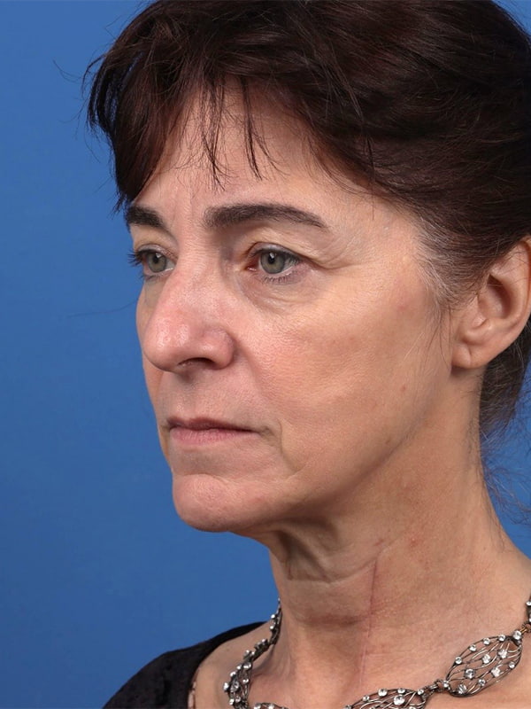 Neck Lift Before & After Image