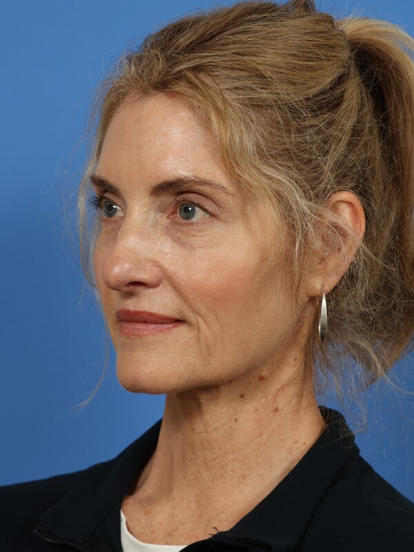 Neck Lift Before & After Image