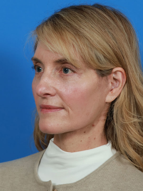 Neck Lift Before & After Image