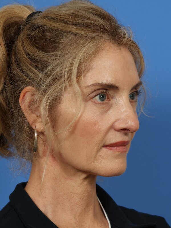Neck Lift Before & After Image