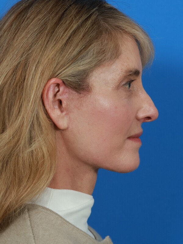 Neck Lift Before & After Image