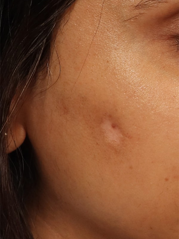 Scar Revision Before & After Image
