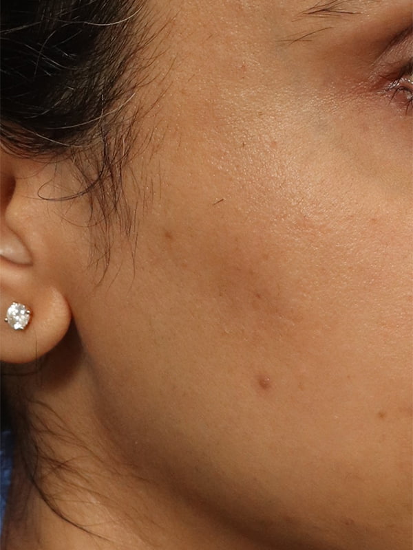 Scar Revision Before & After Image