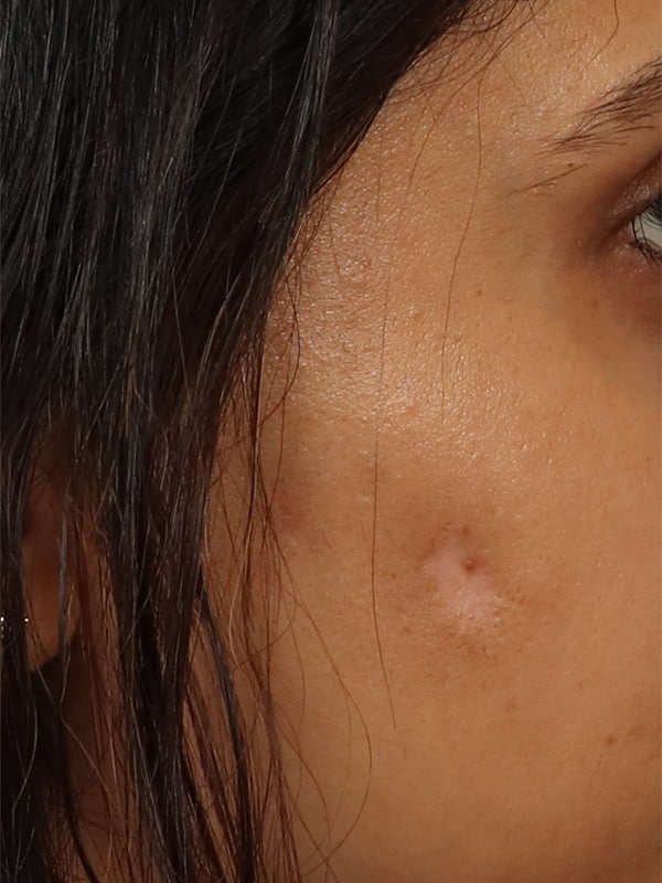 Scar Revision Before & After Image
