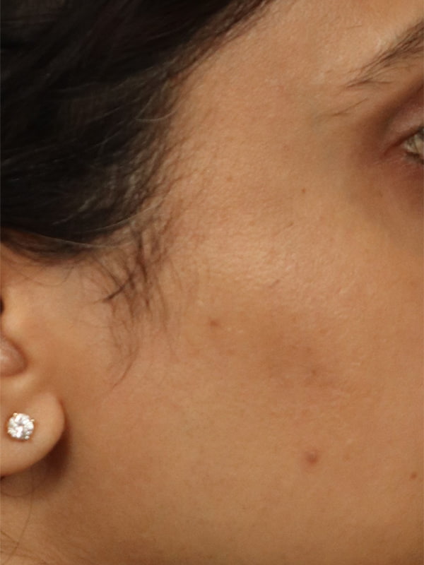 Scar Revision Before & After Image