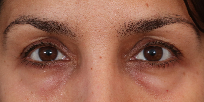 Upper Blepharoplasty Before & After Image