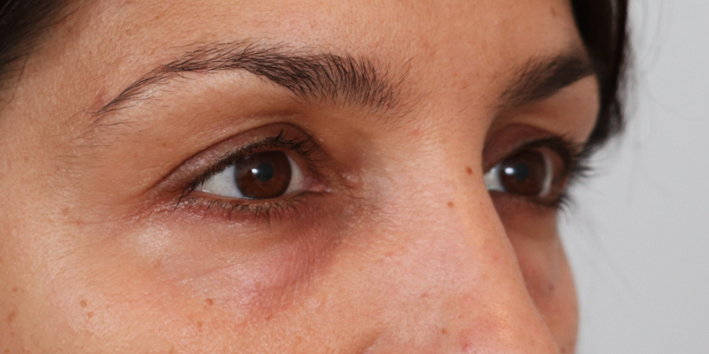 Upper Blepharoplasty Before & After Image