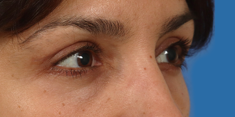 Upper Blepharoplasty Before & After Image