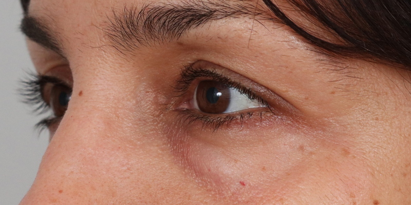 Upper Blepharoplasty Before & After Image