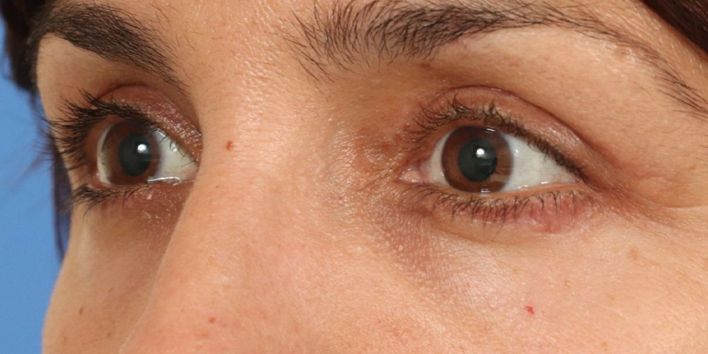 Upper Blepharoplasty Before & After Image