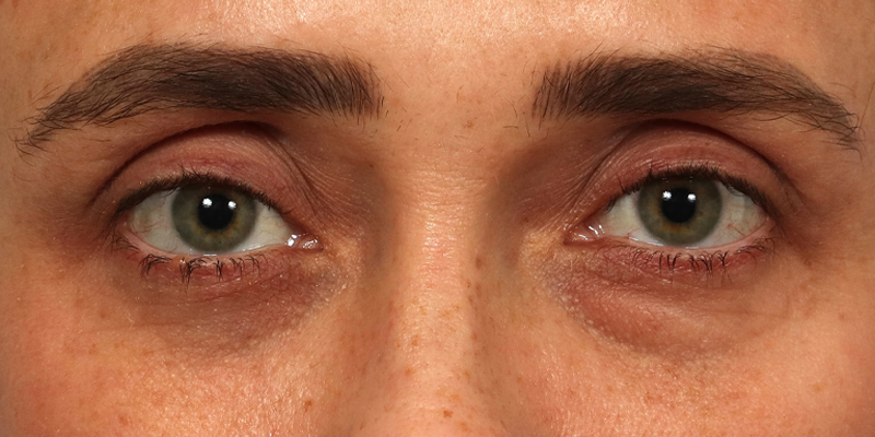 Upper Blepharoplasty Before & After Image