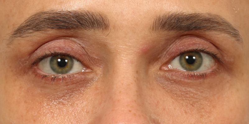 Upper Blepharoplasty Before & After Image