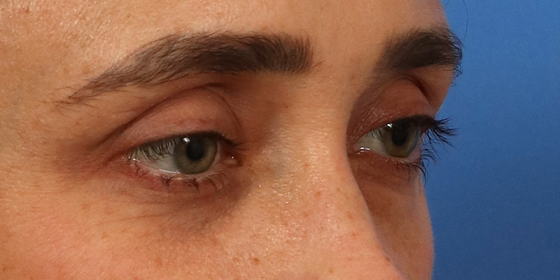 Upper Blepharoplasty Before & After Image