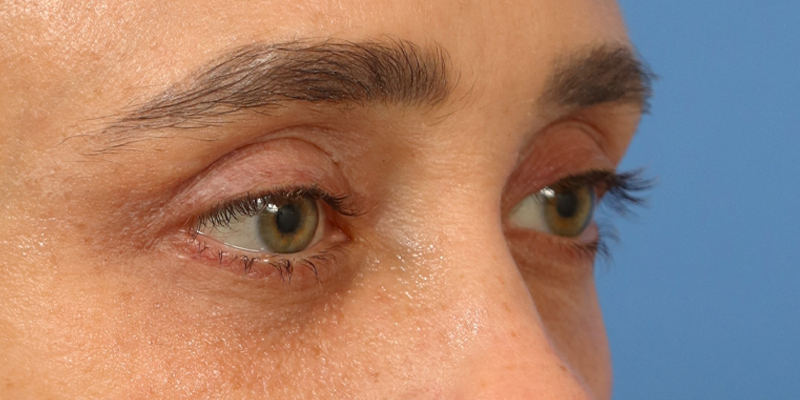Upper Blepharoplasty Before & After Image