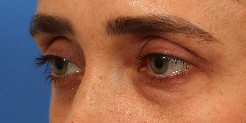 Upper Blepharoplasty Before & After Image