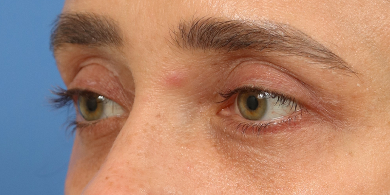 Upper Blepharoplasty Before & After Image