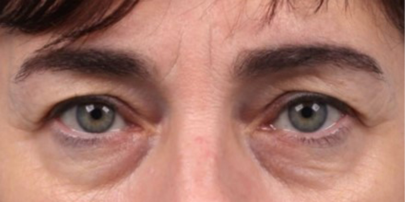 Upper Blepharoplasty Before & After Image