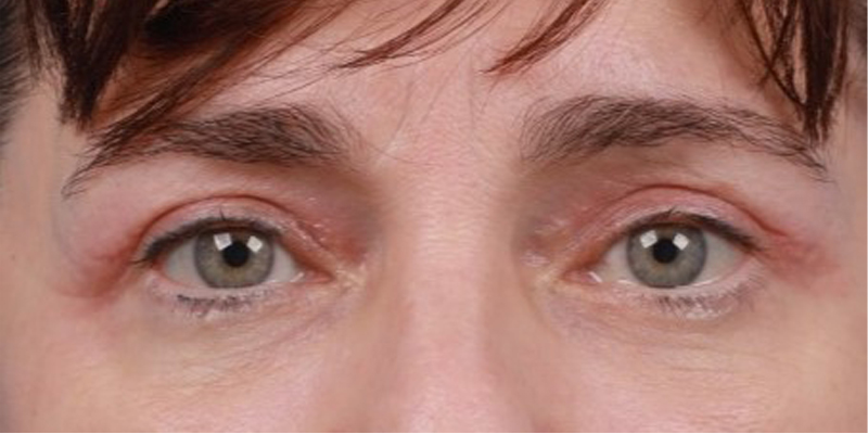 Upper Blepharoplasty Before & After Image