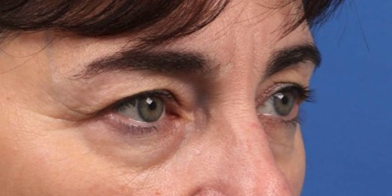 Upper Blepharoplasty Before & After Image