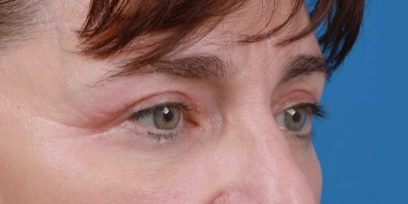 Upper Blepharoplasty Before & After Image