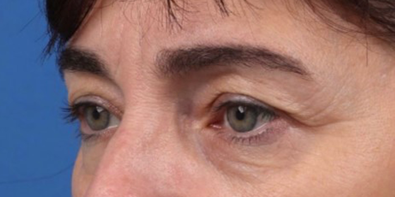 Upper Blepharoplasty Before & After Image