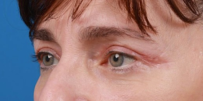 Upper Blepharoplasty Before & After Image