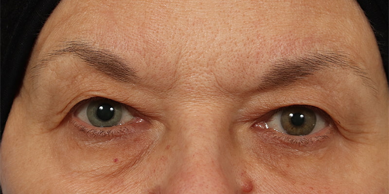 Upper Blepharoplasty Before & After Image