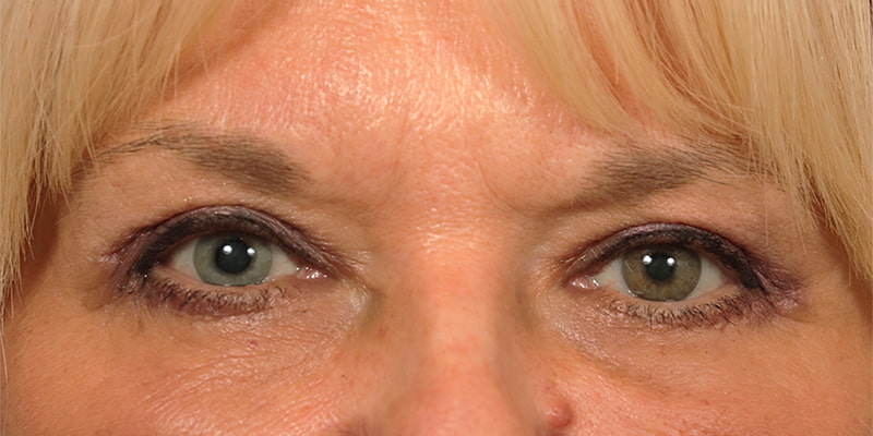 Upper Blepharoplasty Before & After Image