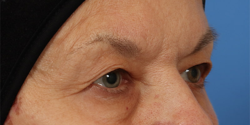 Upper Blepharoplasty Before & After Image
