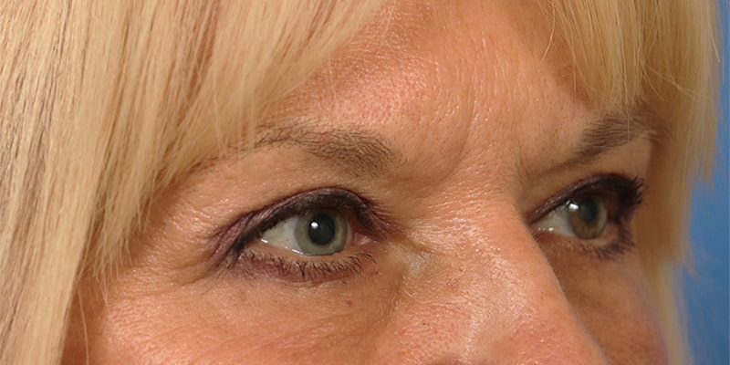 Upper Blepharoplasty Before & After Image