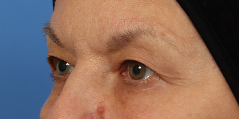 Upper Blepharoplasty Before & After Image