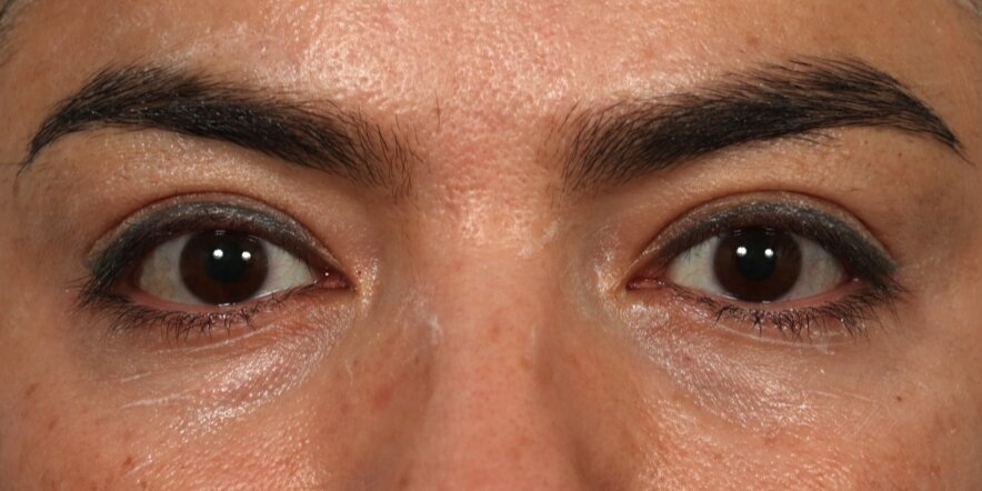 Upper Blepharoplasty Before & After Image