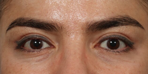 Upper Blepharoplasty Before & After Image