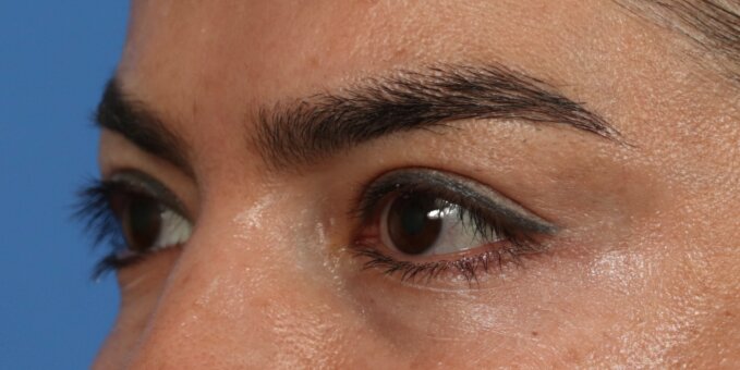 Upper Blepharoplasty Before & After Image