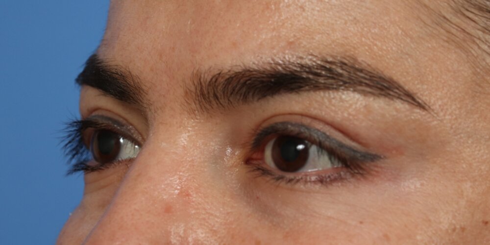 Upper Blepharoplasty Before & After Image