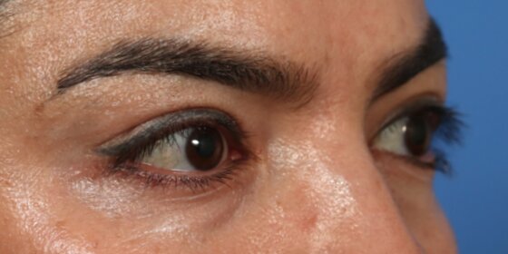 Upper Blepharoplasty Before & After Image