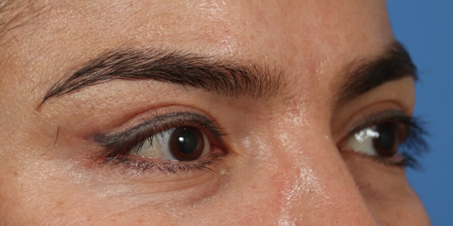 Upper Blepharoplasty Before & After Image
