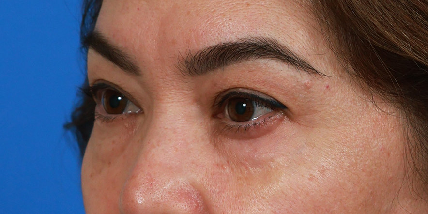 Upper blepharoplasty Before & After Image