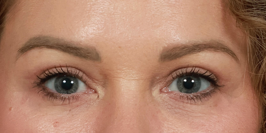 Upper Blepharoplasty Before & After Image