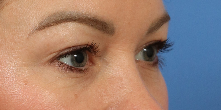 Upper Blepharoplasty Before & After Image