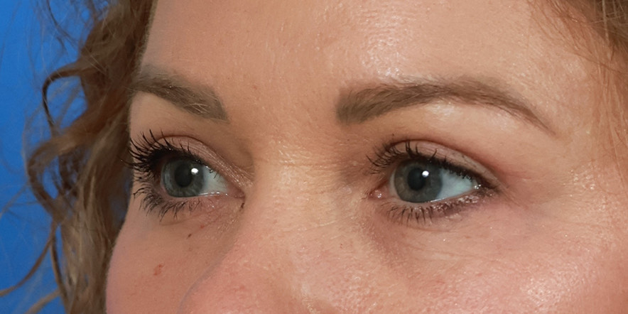 Upper Blepharoplasty Before & After Image