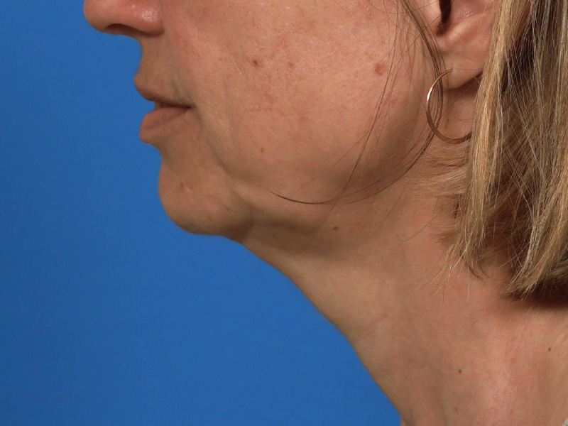 Chin & Jawline Before & After Image